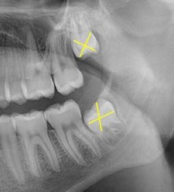 gallery/third molar snip